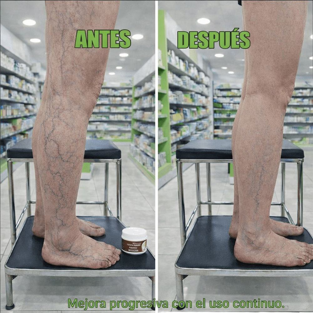 VARICOSE VEINS ™ ¡Piernas ligeras, confianza total!